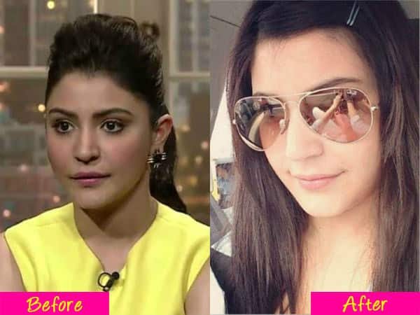 Anushka Sharma plastic surgery - Get Latest News & Movie Reviews