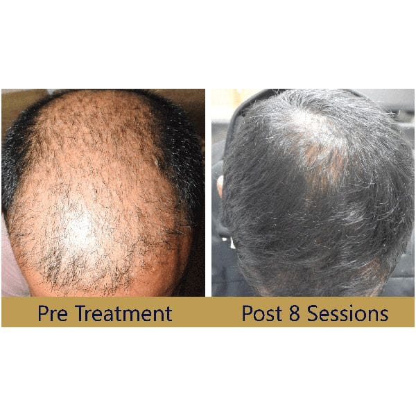 QR 678 Hair Loss Treatment Introduced to UK  B4