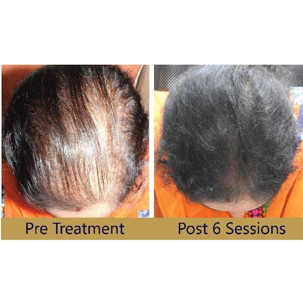 Top Benefits of PRP  GFC Hair Treatments  Bodycraft