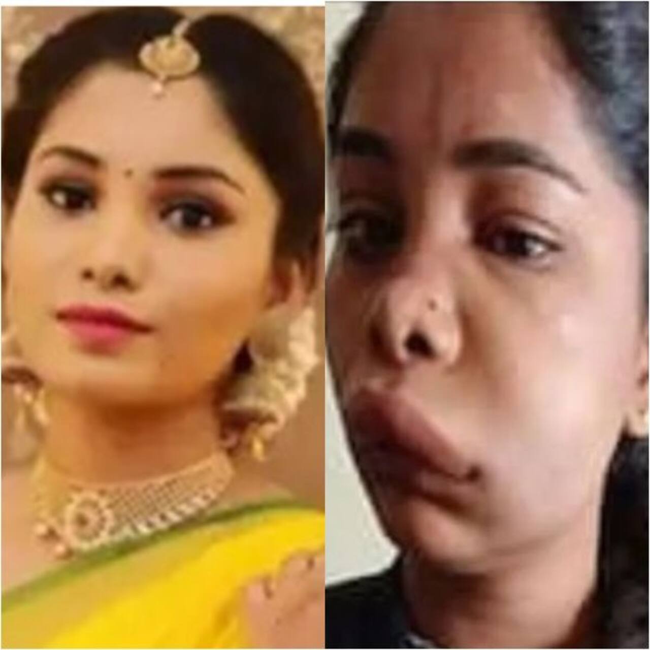 Kannada actress Swathi Sathish's root canal goes horribly wrong; looks