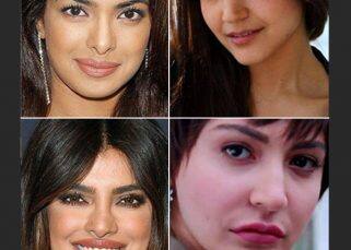 Priyanka Chopra, Anushka Sharma and more Bollywood actresses who fell victim to botched plastic surgery and their results were much worse