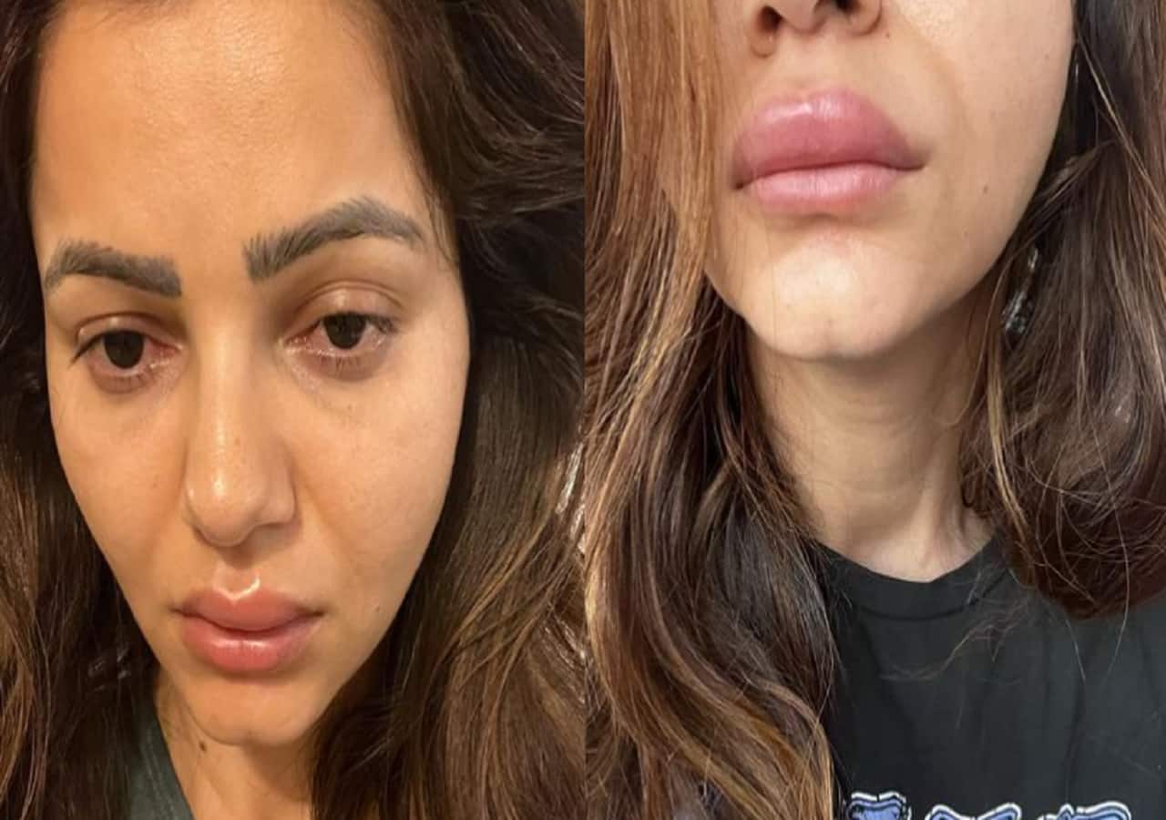 Rubina Dilaik shares her swollen face picture; looks unrecognisable