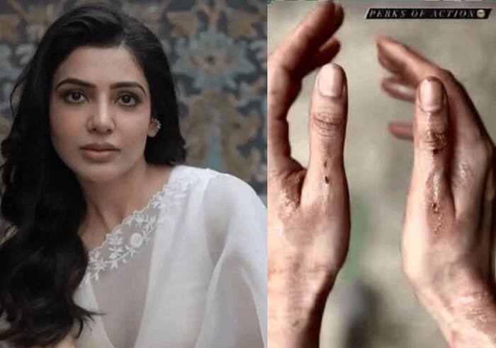 Samantha Ruth Prabhu suffers an injury