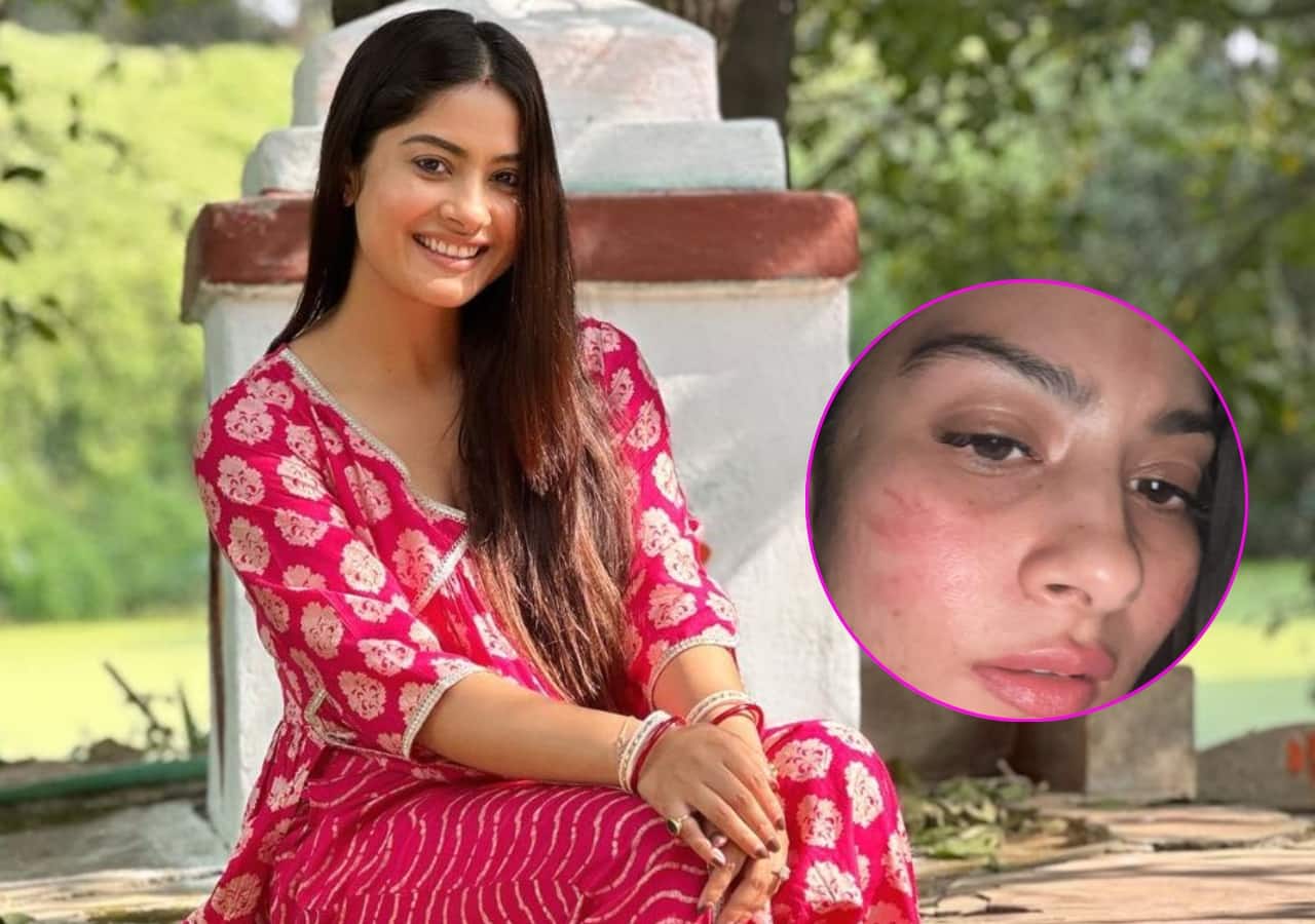 नागिन फेम कृष्णा मुखर्जी की एक गलती की वजह से जल गया चेहरा, एक्ट्रेस ने बुरी हालत में शेयर की फोटो