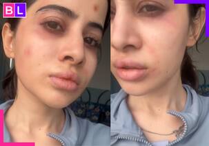 Uorfi Javed का बिगड़ गया पूरा चेहरा, जानें किस वजह से हुआ एक्ट्रेस का ये हाल- Video