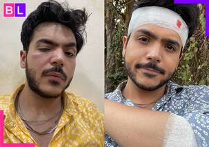 शूटिंग के दौरान गंभीर रूप से घायल हुए TMKOC के एक्स टप्पू, बाल-बाल फूटने से बची आंख