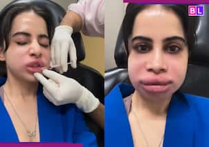 Urfi Javed ने लिप फिलर रिमूव कराते हुए दिखाई झलक, एक्ट्रेस का दर्द से हुआ बुरा हाल, देखें वीडियो