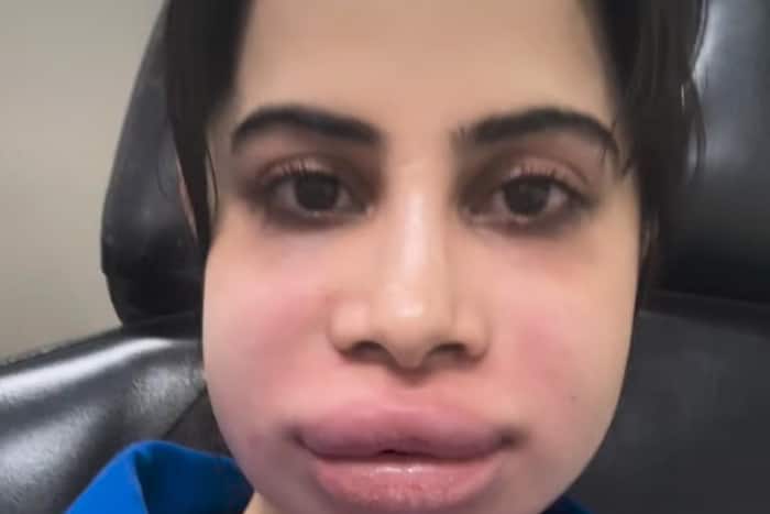 Urfi Javed shocks all with her swollen face pictures