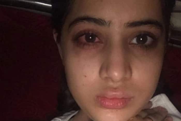 Urfi Javed reveals getting lip fillers