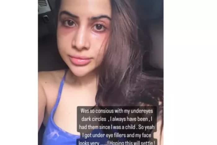Urfi Javed opted for dark circle surgery